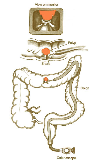 Illustration of an image guided endoscopy partial colectomy.
