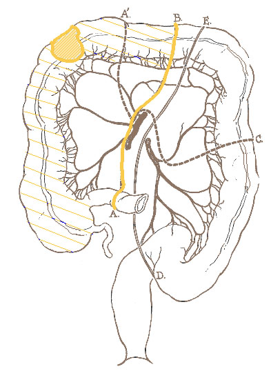 Illustration of the right hemicolectomy for Hepatic Flexure CA.