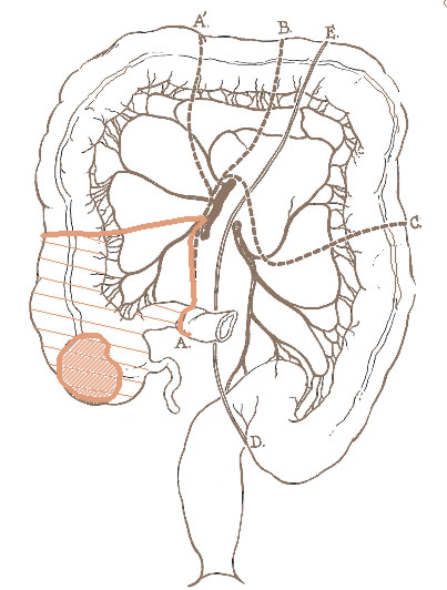 Illustration of a partial colectomy.