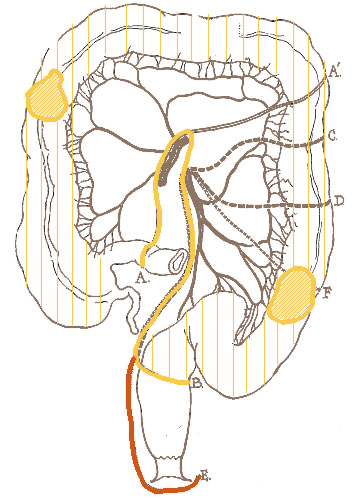 Illustration of the right hemicolectomy with lower line.
