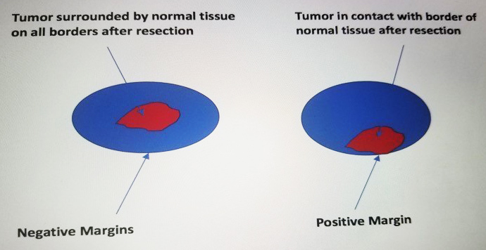 Diagram depicts a negative margin on the left in which there is normal tissue on all borders of the resected cancer specimen and a positive margin on the right showing tumor in contact with one border of normal tissue after surgical resection of a cancerous tumor.