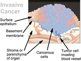 Depiction of an invasive tumor
