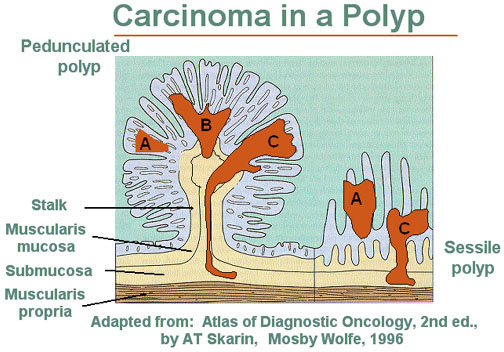 villous adenoma vs tubular adenoma