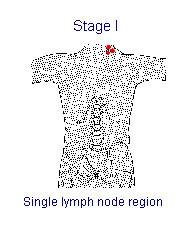 Illustration of Stage I: Single lymph node region