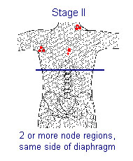 Illustration of Stage II: 2 or more node regions, same side of diaphragm