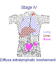 Illustration of Stage IV: Diffuse extralymphatic involvement
