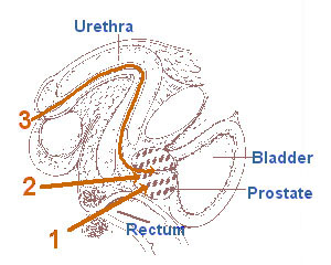 Illustration of the prostate, rectum, bladder, and urethra