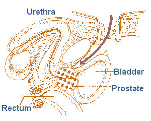 Illustration of the prostate, bladder, urethra, and rectum
