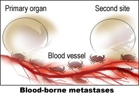 Blood-bourne metastases.