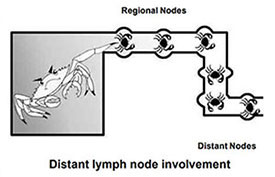 Travel in lymph channels beyond the first (regional) drainage area. Tumor cells can be filtered, trapped and begin to grow in any lymph nodes in the body.