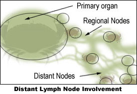 Distant lymph node involvement.