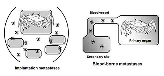 Left Image: Spread through fluids in a body cavity. Example: malignant cells rupture the surface of the primary tumor and are released into the thoracic or peritoneal cavity. They float in the fluid and can land on and begin to grow on any tissue
reached by the fluid. This type of spread is also called implantation or seeding metastases. Some tumors form large quantities of fluid called ascites that can be removed, but the fluid rapidly re-accumulates. However, the presence of fluid or ascites does not automatically indicate dissemination. There must be cytologic evidence of malignant cells. Right Image: Hematogenous or blood-borne metastases. Invasion of blood vessels within the primary tumor (veins are more susceptible to invasion than thicker-walled arteries) allows escape of tumor cells or tumor emboli which are transported through the blood stream to another part of the body
where it lodges in a capillary or arteriole. At that point the tumor penetrates the vessel wall and grows back into the surrounding tissue.