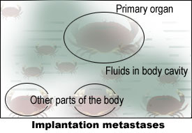 Implantation metastases.