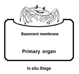 In situ means “in place.” The technical definition of in situ is the presence of malignant cells within the cell group from which they arose. There is no penetration of the basement membrane of the tissue and no stromal invasion. Generally, a cancer begins in the rapidly dividing cells of the epithelium or lining of an organ and grows from the inside to the outside of the organ. An in situ cancer fulfills all pathologic criteria for malignancy except that it has not invaded the supporting structure of organ on which it arose.