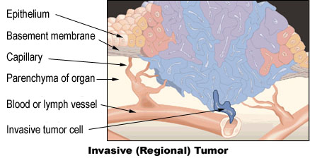 Invasive (regional) tumor with arrows identifying the epithelium, basement membrane, capillary, parenchyma of organ, blood or lymph vessel, and invasive tumor cell.