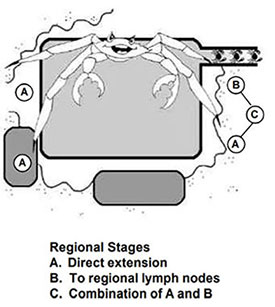 These codes and subcategories describe different methods of regional spread of tumor: A. Direct Extension: Invasion through entire wall of organ into surrounding organs and/or adjacent tissues (code 2, regional by direct extension or contiguous spread) B. To regional lymph nodes: Tumor invasion of walls of lymphatics where cells can travel through lymphatic vessels to nearby lymph nodes where they are “filtered” out and begin to grow in the nodes (code 3, regional to lymph nodes) C. Combination of A and B: A combination of direct extension and lymph node involvement (code 4, regional by direct extension and to regional nodes).