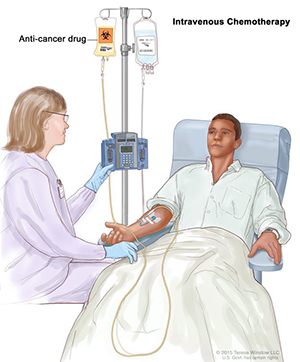 Intravenous (IV) chemotherapy; drawing of an anti-cancer drug being given to a patient through a vein in the arm.